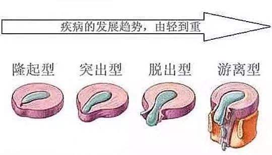 膏藥怎么治療治腰間盤突出